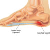 Fascite plantare: rimedi. Come curarla con l’osteopatia.