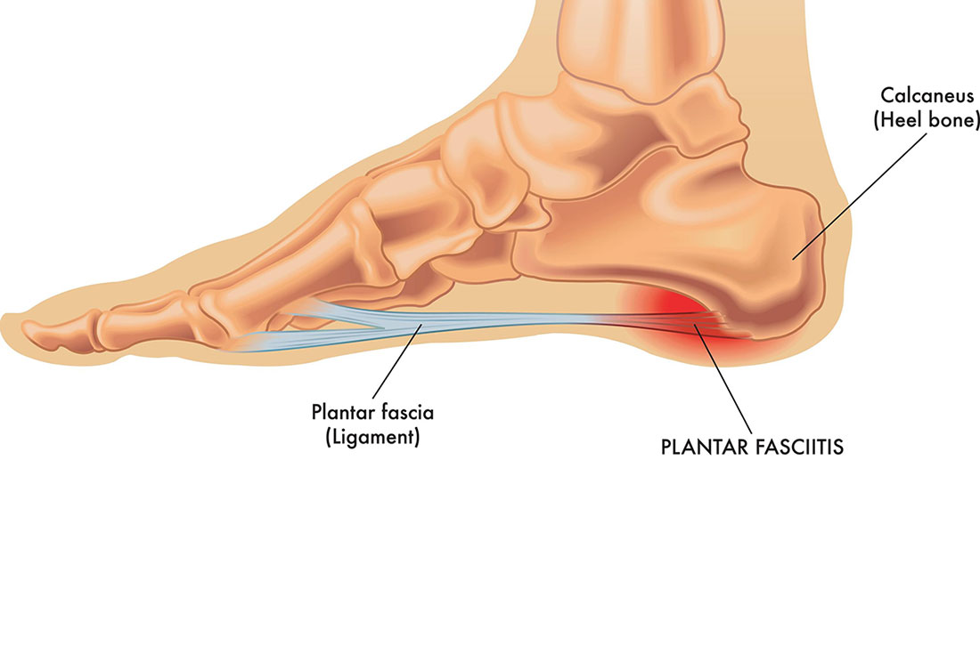 Fascite plantare: rimedi. Come curarla con l’osteopatia.